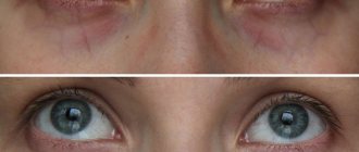 Wreaths around the eyes