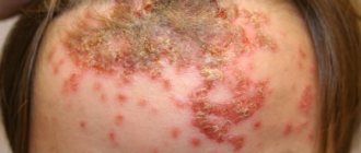 Types of skin disease