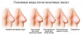 Types of breast ptosis