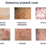 Виды угревой сыпи