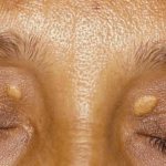 Возникновение ксантелазм - один из поводов обратиться к пластическому хирургу