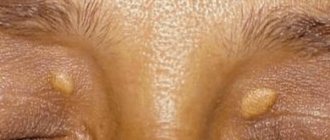 The occurrence of xanthelasma is one of the reasons to consult a plastic surgeon