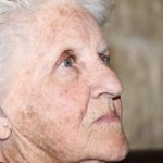 age spots on the face causes and treatment