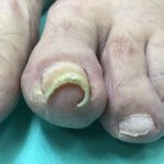 Вросший ноготь. Удаление вросшего ногтя в Москве хирургическим путем