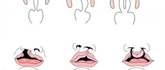 cleft lip and cleft palate schematically