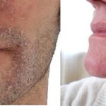 Жирная кожа шелушится - причины и уход