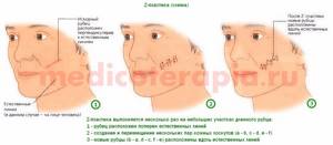 Пластика рубцов фото Бухаров откуда шрам